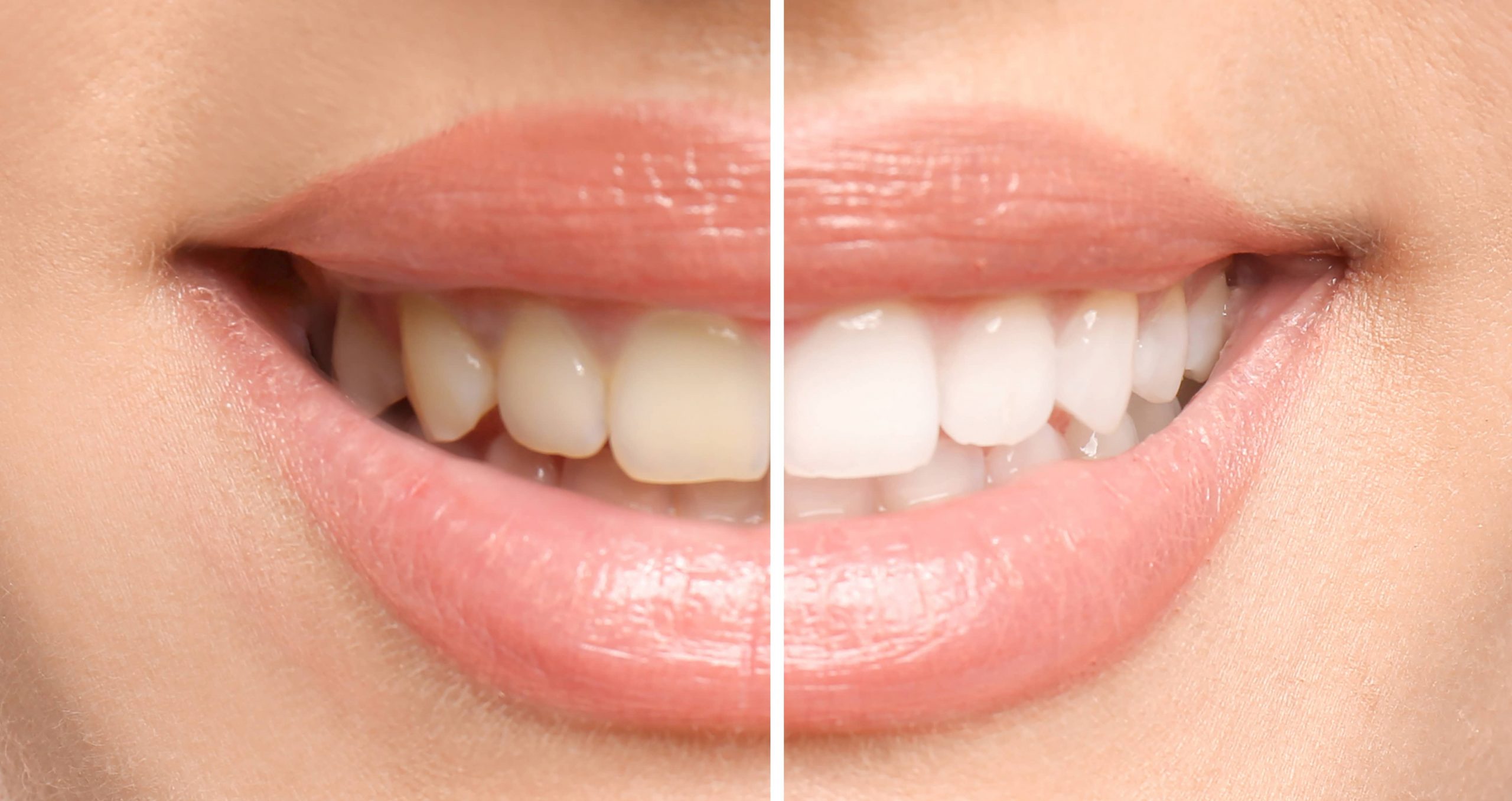 Zähne nach einer Bleachingbehandlung - Zahnarzt München Schwabing